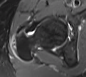 Torn abductors axial MRI