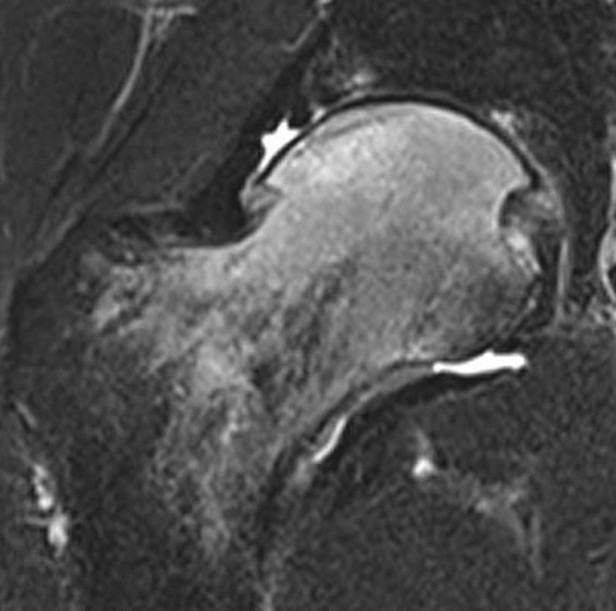 Transient osteoporosis hip