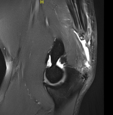 MRI triceps avulsion 3