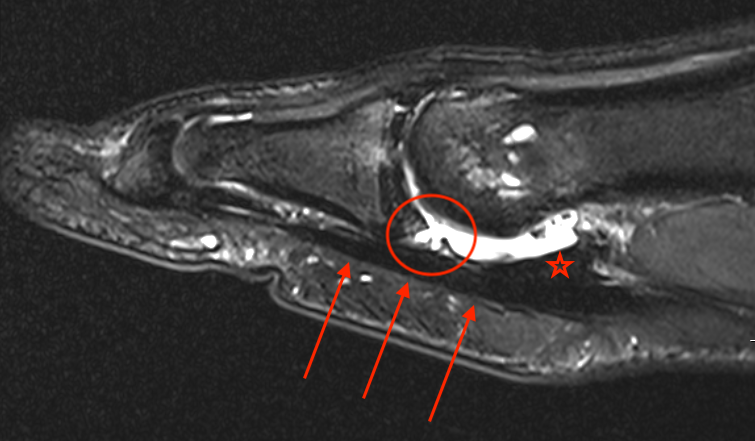 Turf toe MRI