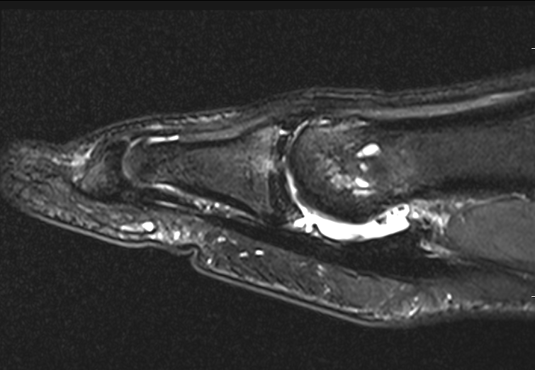 Turf toe MRI