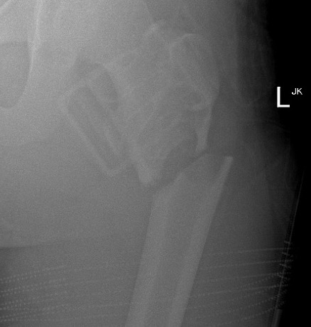 UBC fractured femur