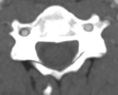 Vertebral artery 3