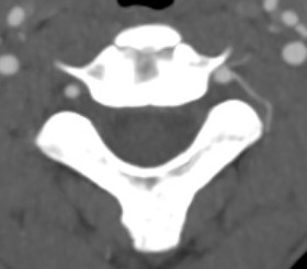 Vertebral artery 4