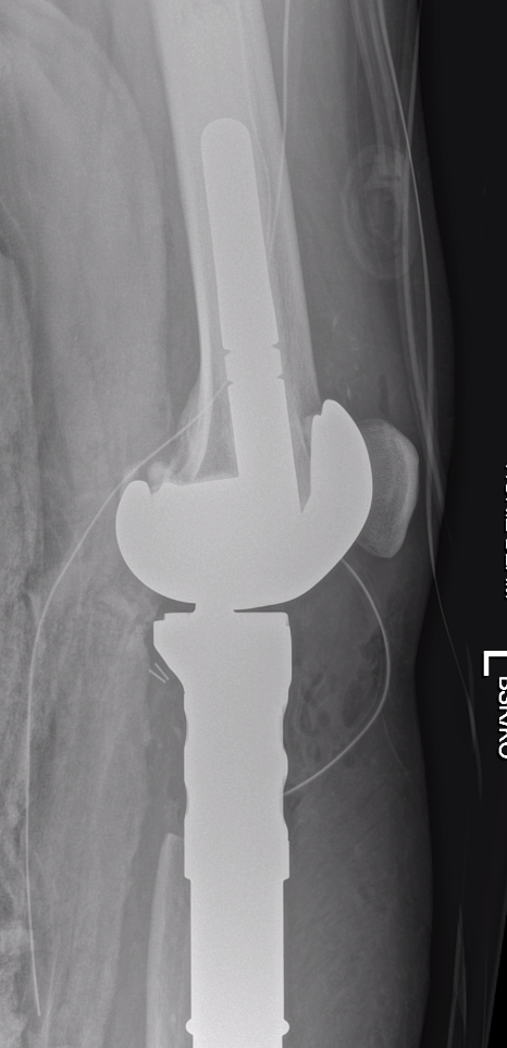 Parosteal tibia resection