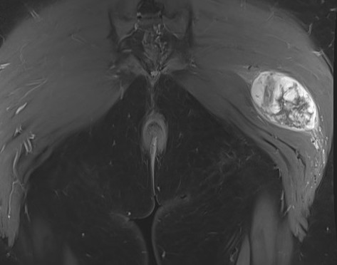 Sarcoma buttock