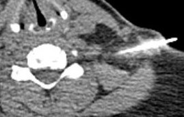 Nerve root injection 1