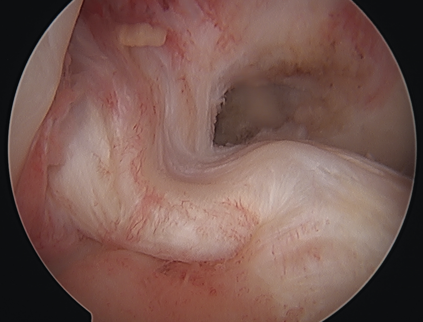 PCL tear with ACL laxity 1