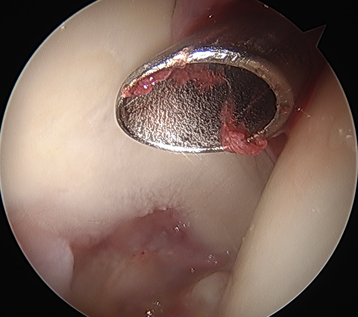 Mid anterior portal