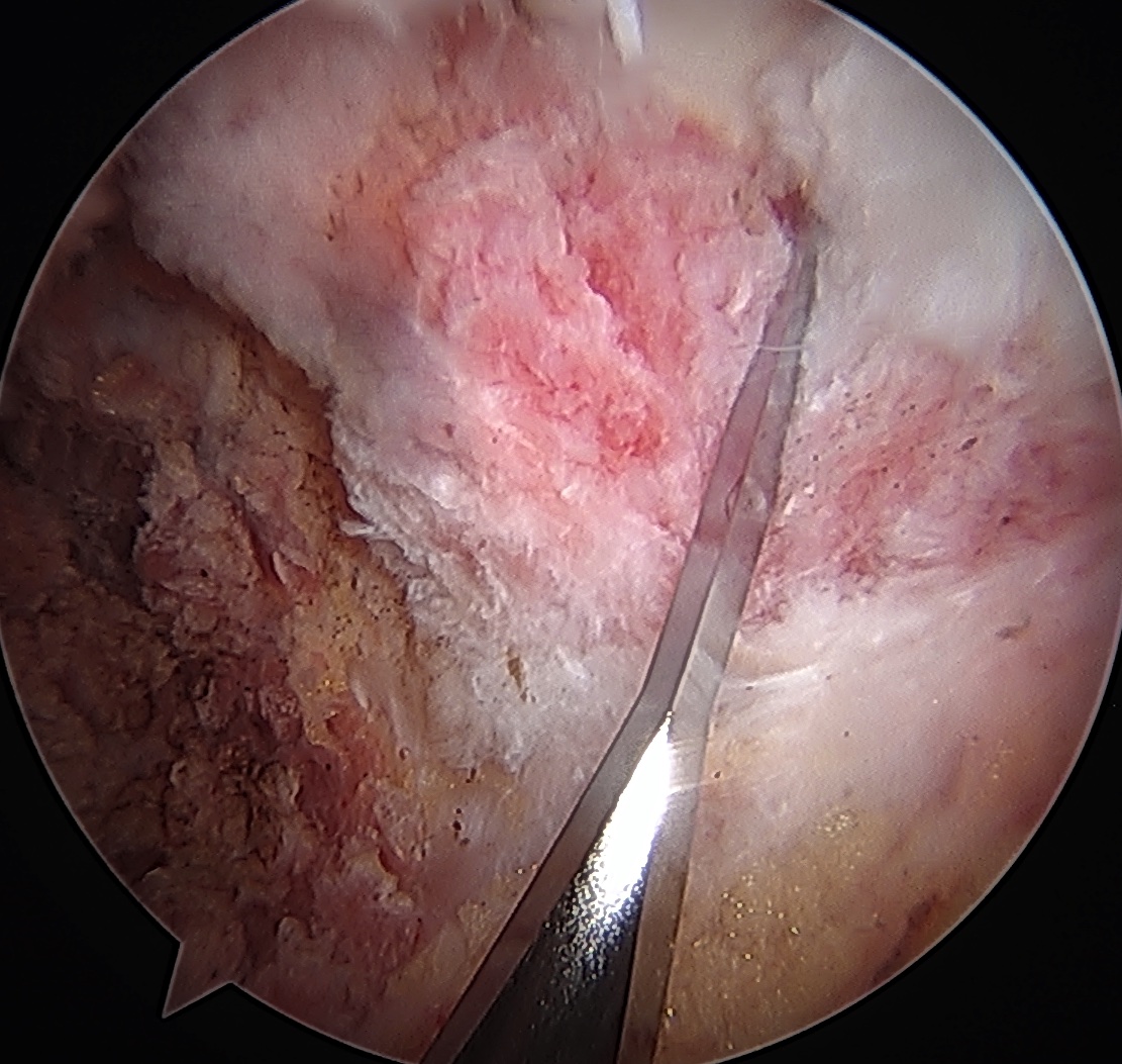 T Capsulotomy