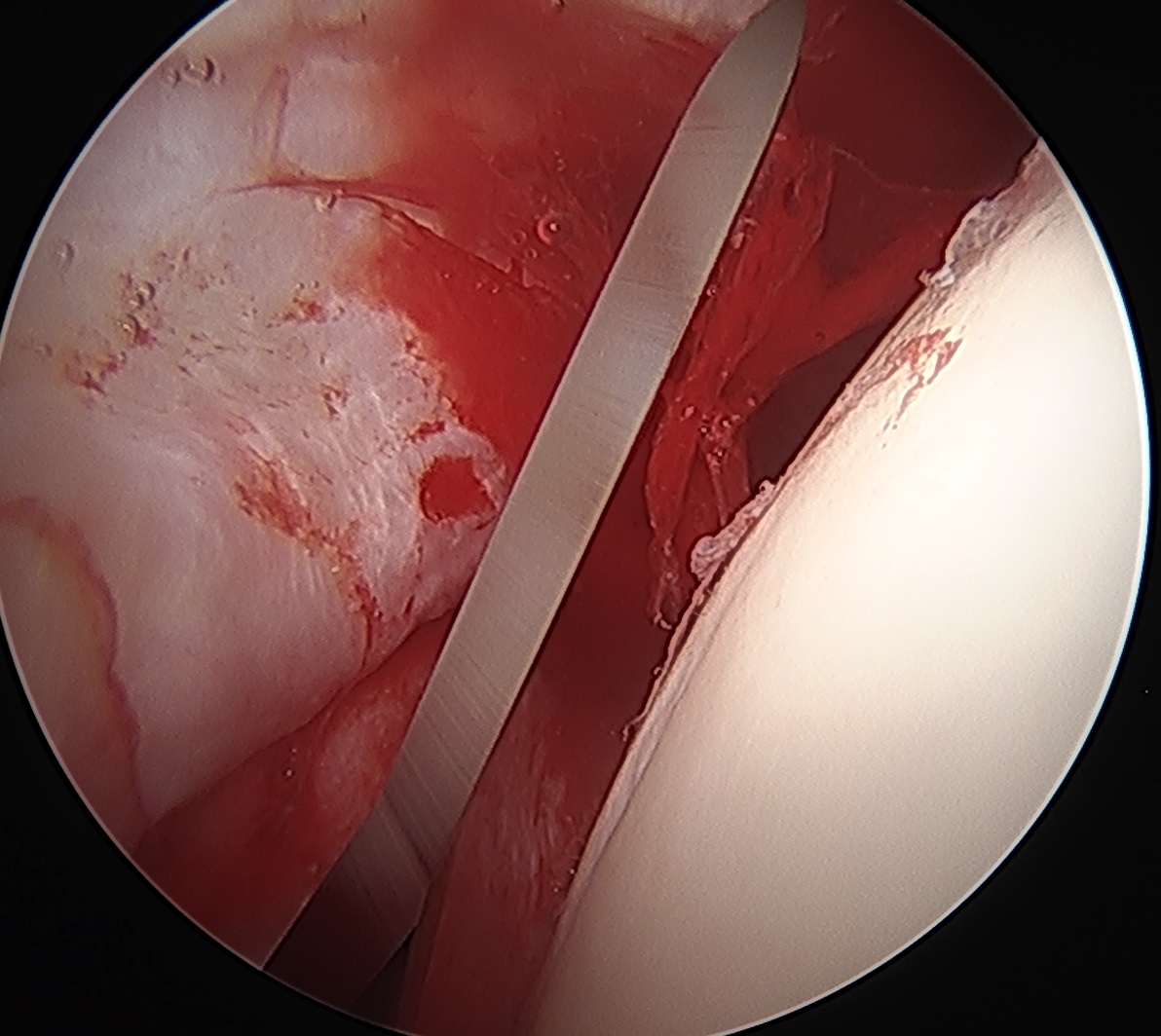 Interportal capsulotomy 1