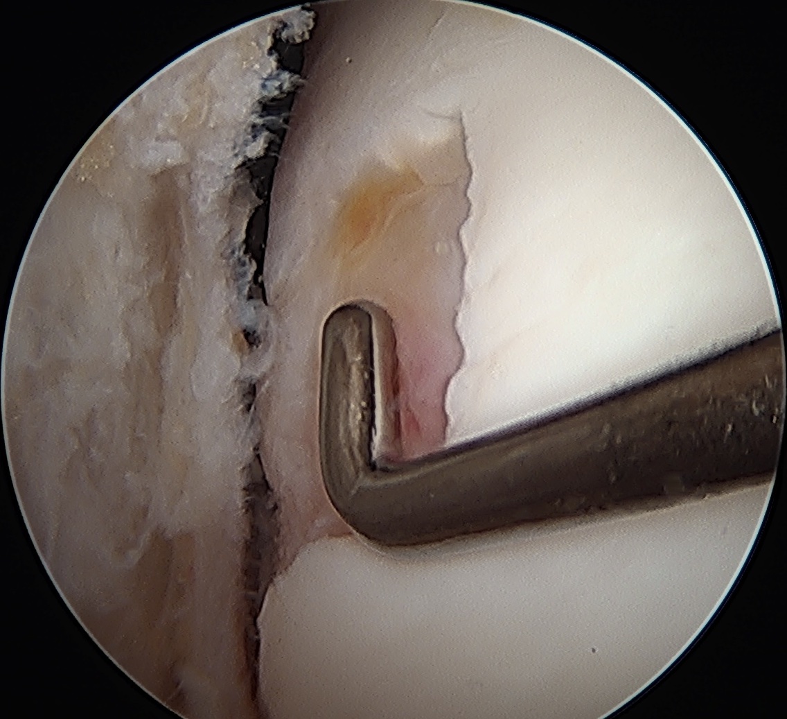 Cartilage sizing