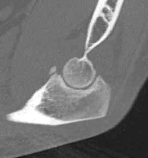 Type 1 coronoid