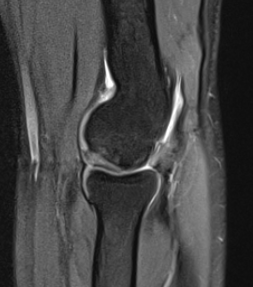 Elbow OCD MRI displaced