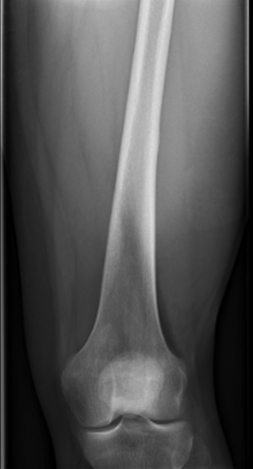 Ewings midshaft femur