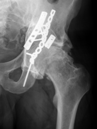 Acetabular fracture