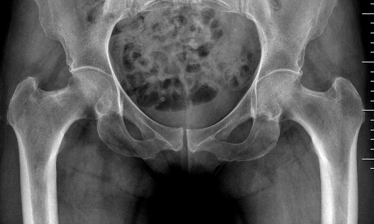 Femoral stress coxa vara