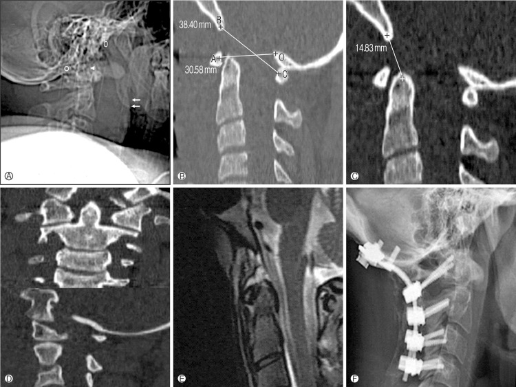 Atlanto occipital dislocation