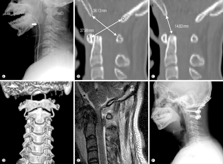 Atlanto occipital dislocation