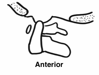 Atlanto occipital dislocation anterior