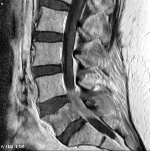 vert lymphoma 1