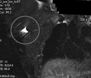 MRI Pec major tear 2